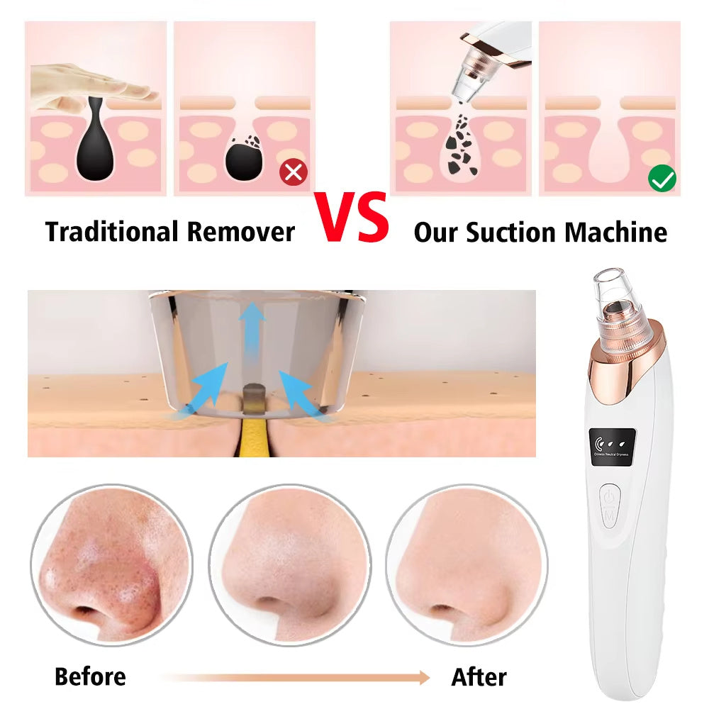 Electric Professional Blackhead Remover