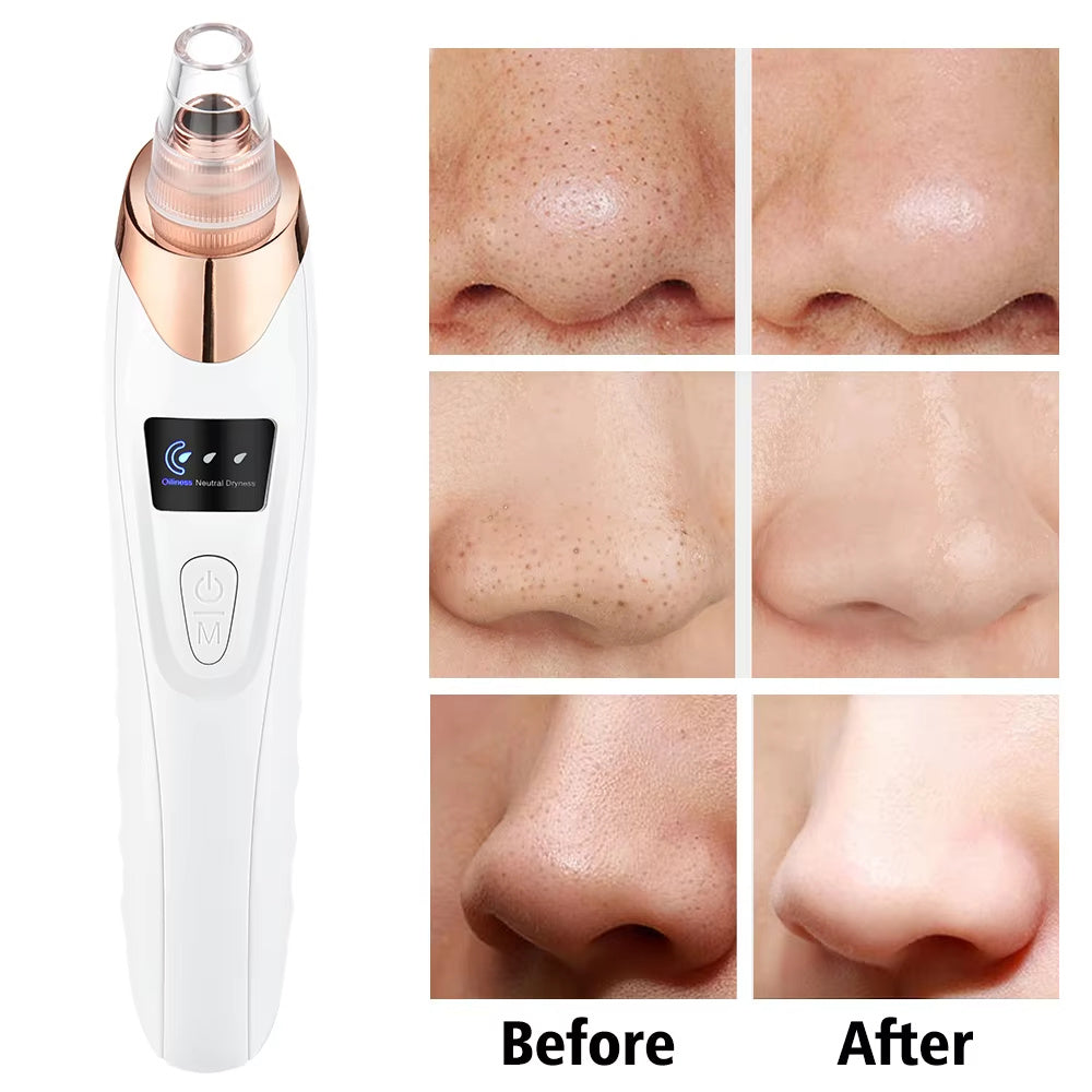 Electric Professional Blackhead Remover